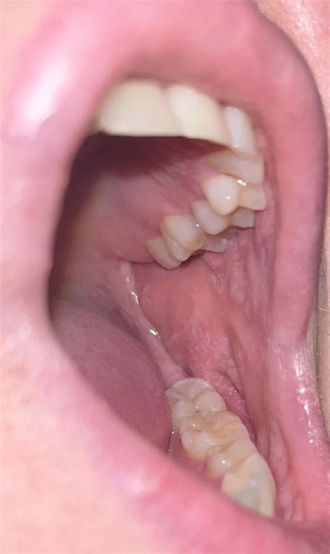 White Spots and irritation in mouth : r/askdentists