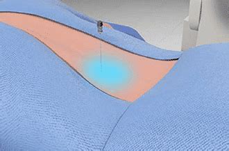 Selective Nerve Root Block in Knoxville - Omega Pain Management