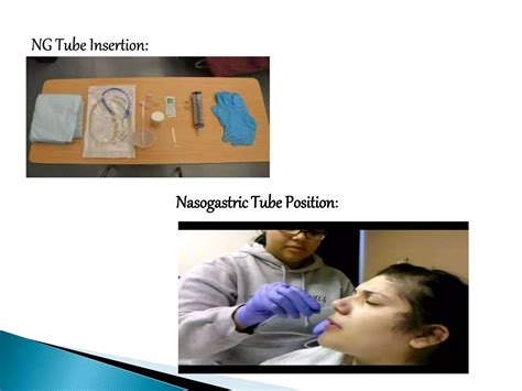 Nasogastric tube (NG tube) | PPTX