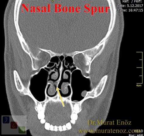 What's A Bone Spur