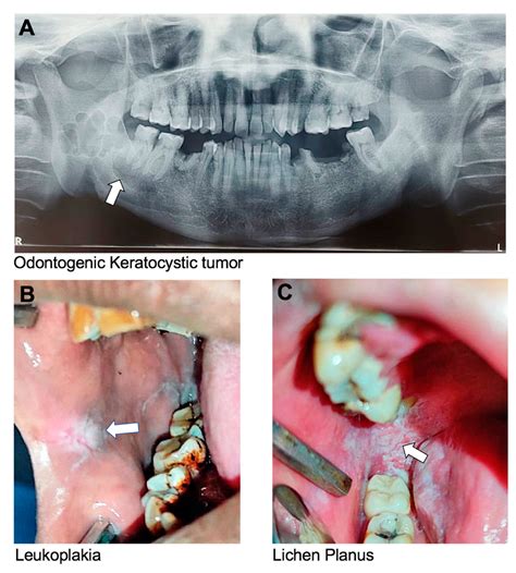 The Role of Genetics in Human Oral Health: A Systematic–Narrative Review