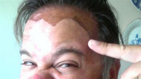 TMZ's Summer Sunburn Snapshots Contest