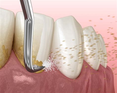 Where to get dental implants - Caffaratti Dental Group - Sparks, NV
