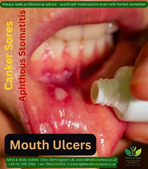 Mouth Ulcers Baby Mouth Ulcers Causes & Treatments | Colgate® IN