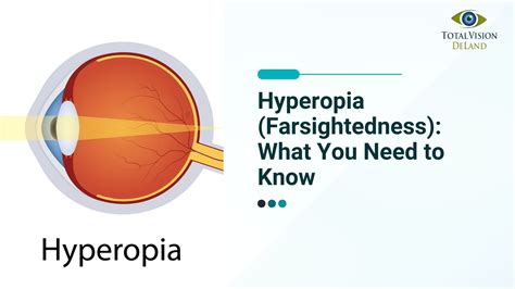 Hyperopia (Farsightedness): What You Need to Know - Total Vision of Deland