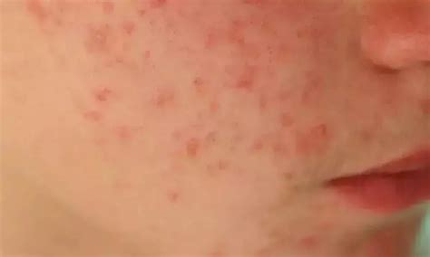 Isotretinoin users for acne not at increased risk of suicide or ...