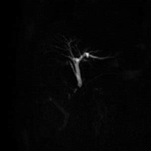 Image result for MRCP Biliary Tree