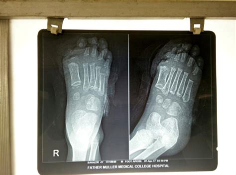 Hand & Micro Surgery|FATHER MULLER MEDICAL COLLEGE HOSPITAL