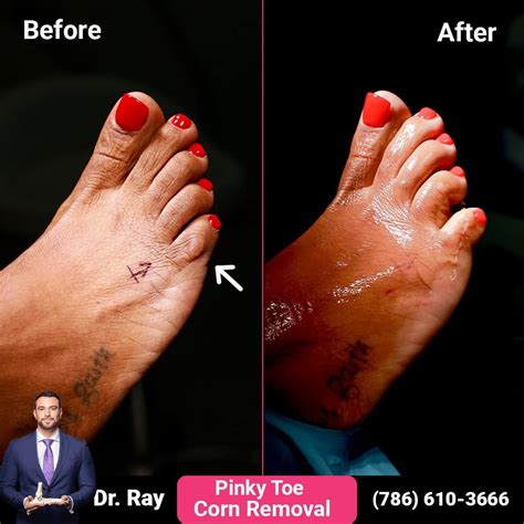 Corn Removal Surgery Before and After Photos - Luxe Foot Surgery