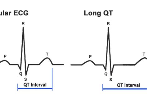 Provocative testing useful for diagnosis of congenital long QT syndrome ...