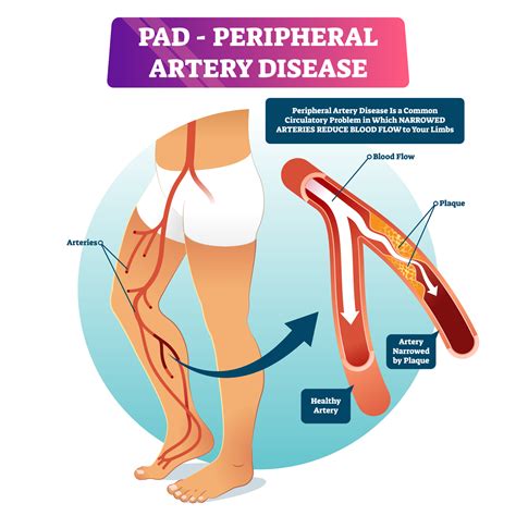 PAD Awareness Month - Premier Surgical