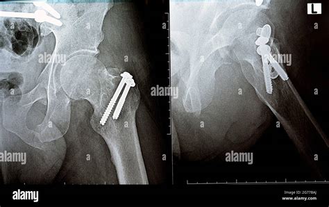 Image result for Open Fracture Surgery