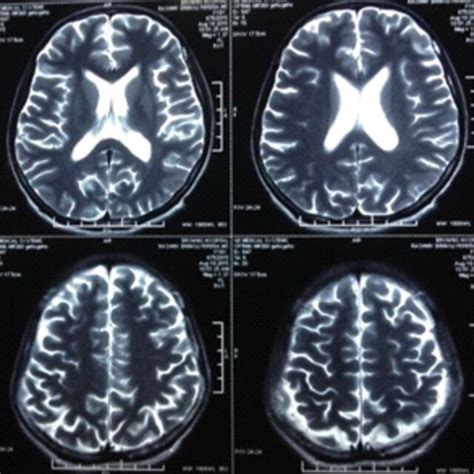 Image result for Diffuse Atrophy