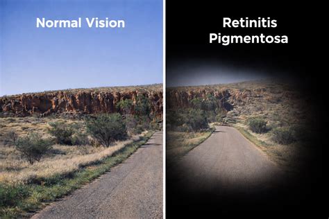 How to Fix Astigmatism Naturally? 3 Easy Ways
