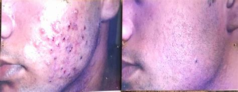 Accident Scars,Chicken Pox Scars,Burn Scars Treatment Doctor Hospital ...