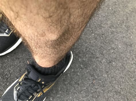 Is It Normal To Have Bumpy Shins at Rose Braddon blog