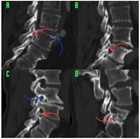 Classification of Osteophytes Occurring in the Lumbar Intervertebral ...