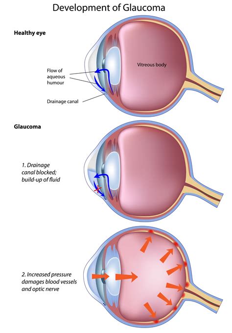 Glaucoma and Glaucoma Treatment | EYE DAY CLINIC