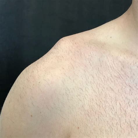 Female Lump On Shoulder at Beulah Insley blog