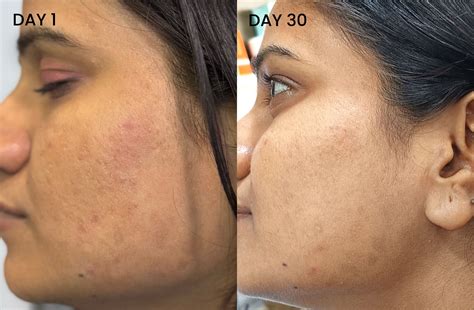 Buy AHA BHA Serum With Salicylic and Glycolic Acid | Foxtale