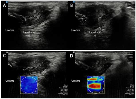 The Correlation between Transperineal Shear-Wave Elastography and ...