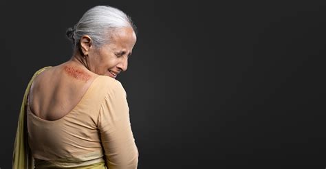 Shingles (Nagin Disease, Akki Disease) : Symptoms, Causes and Treatment ...
