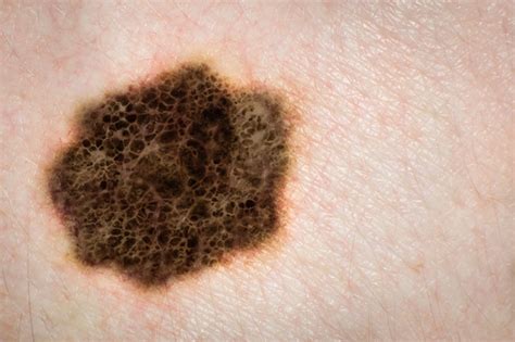 Melanoma Monday | University of Utah Health
