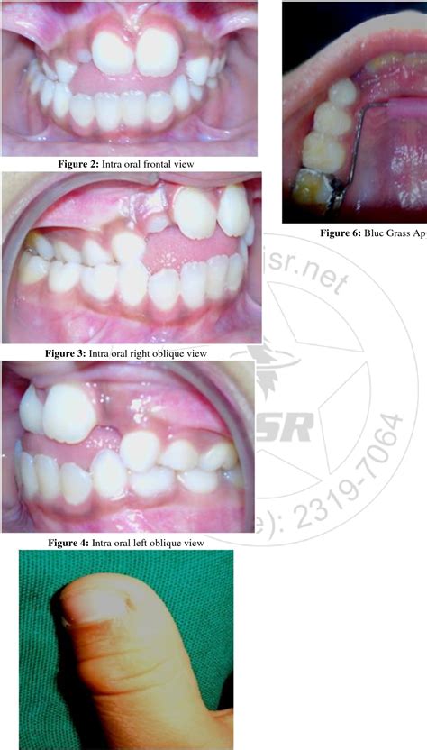 [PDF] Management of Thumb Sucking Habit in a 8 Year Old Child – A Case ...