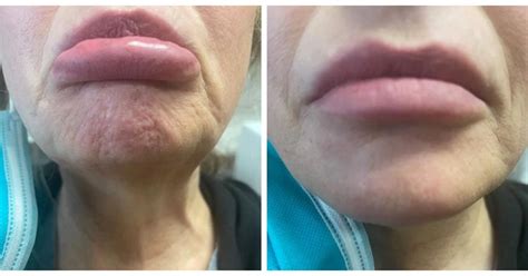 Image result for Chin Botox