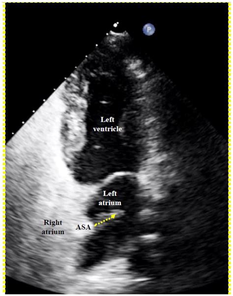 Every Patent Foramen Ovale Should Be Closed