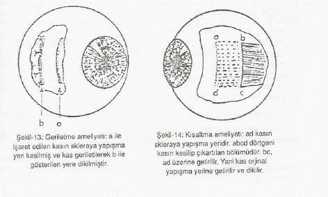 Şaşılık