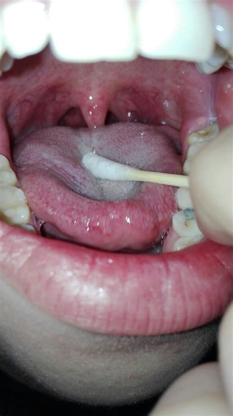 咽喉部有一小条白色的跟溃疡似的东西，是咽炎吗？吞咽有异物感，总觉得有痰。照片照的口腔有点红，实际是_百度知道