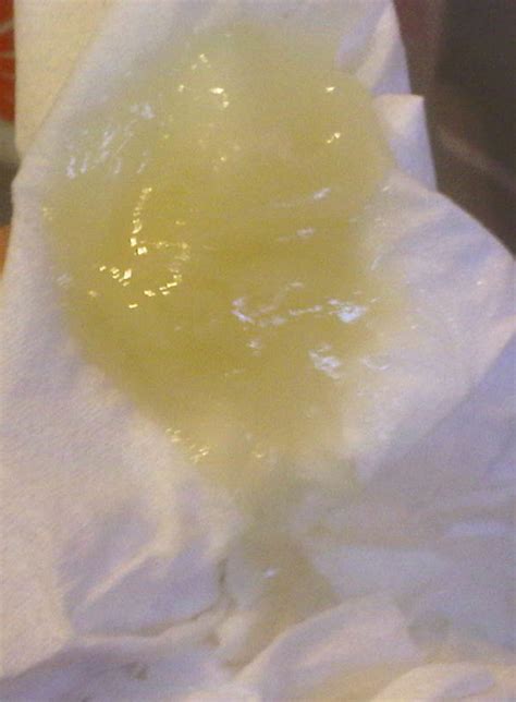 Gelatin Looking Discharge at Ann Shafer blog