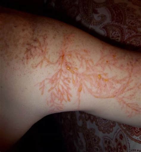 Lichtenberg Figures: The Fractal Patterns of Lightning Strike Scars ...