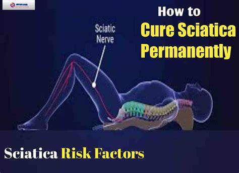 How to Cure Sciatica Permanently? | Sciatica | Sciatica Symptoms,Causes &Treatment