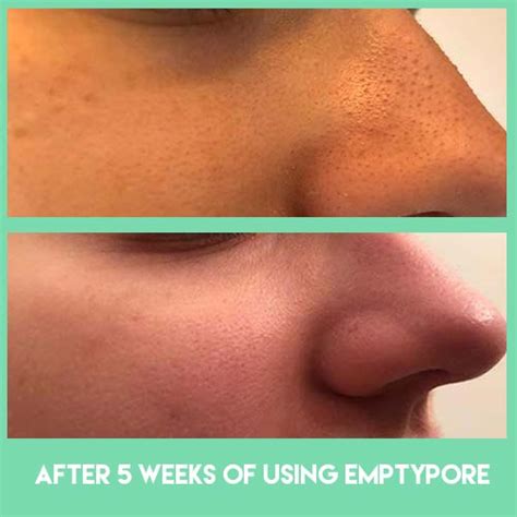 Image result for Sebum Plug Extraction