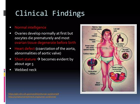 Turner's Syndrome | PDF