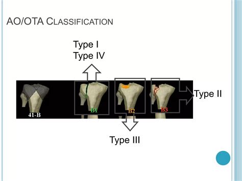 Proximal Tibia 的图像结果
