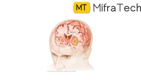 Computer Vision for Tumour 的图像结果