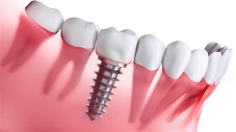 What to Expect During a Dental Implant Procedure & Its Advantages? - dental implant images