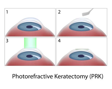 Photorefractive Keratectomy Prk Surgery