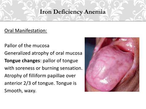 Oral manifestation of bleeding disorders | PPTX