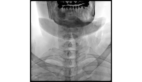 Philips - Zenition 30 - Mobile C-arm with Flat Detector