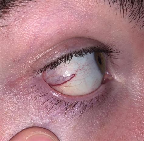 What is this squiggly red line in my eye? : r/medical