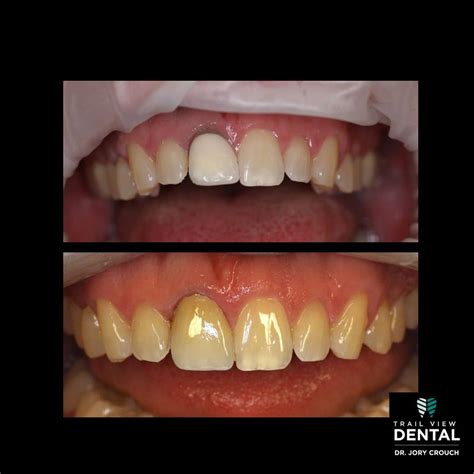 Smile Gallery - Trail View Dental