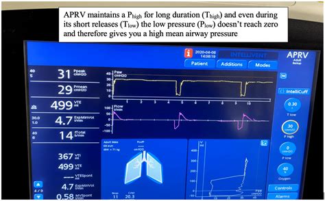 APRV Mode Explained 的图像结果