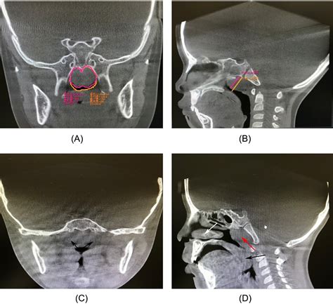 Adenoids In Children Surgery For Tonsils And Adenoids | Is Adenoids