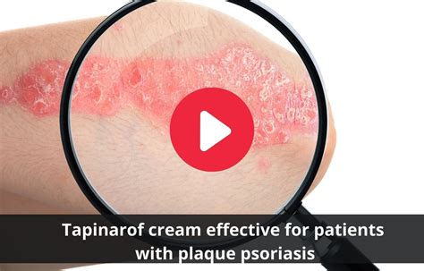 Tapinarof cream beneficial for plaque psoriasis patients