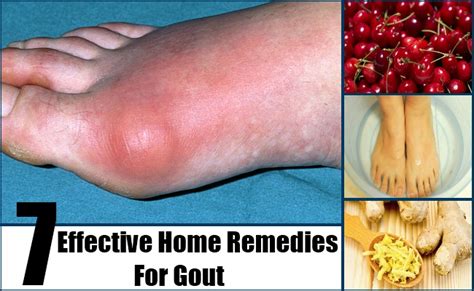 Gout Home Remedies, Natural Treatments And Cures | Lady Care Health