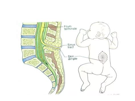 Congenital hemivertebra and tethered cord syndrome | PPTX